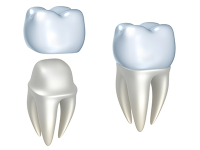 What Are The Key Components Of A Zirconia Crown Process?