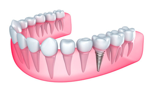 Benefits of Dental Implants