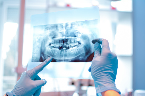 Gloved hands holding up a dental x-ray at Irvine Dentistry.