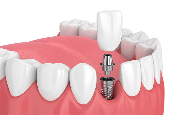 Rendering of jaw with dental implant at Irvine Dentistry in Irvine, CA.