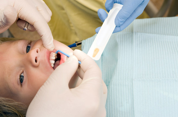 Young boy receiving fluoride treatment at Irvine Dentistry.