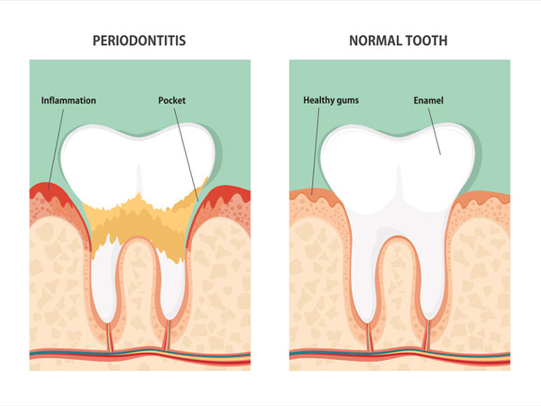 Diagram of periodontitis and health tooth at Irvine Dentistry