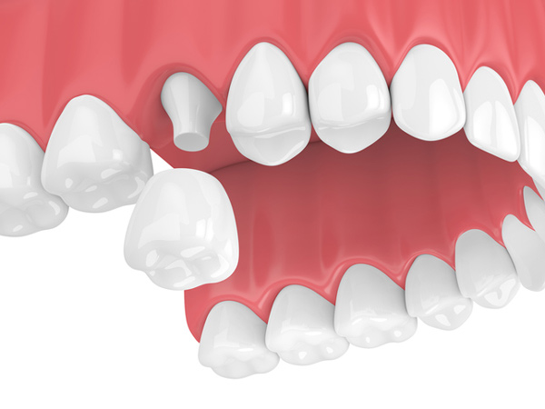 Rendering of jaw with dental crown at Irvine Dentistry in Irvine, CA
