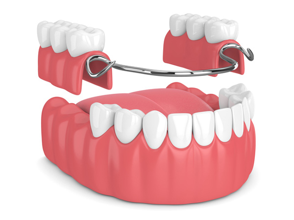 Rendering of removable partial denture at Irvine Dentistry in Irvine, California.