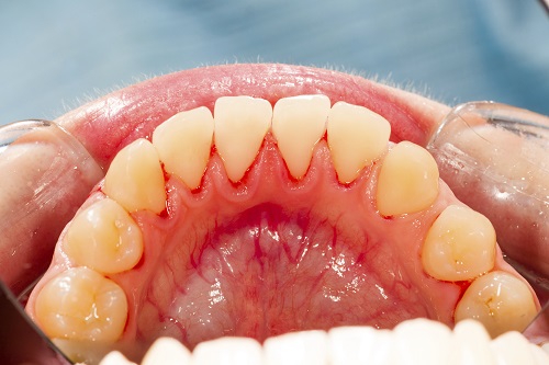 How Can I Get Rid of Gum Disease?