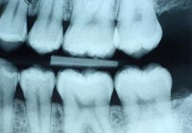 Close-up Teeth X-ray of molars